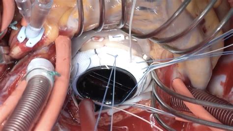 On X Mitral Valve Mv Replacement Broadcastmed