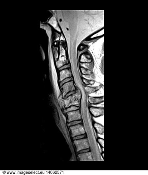 Cervical Spine Fracture Cervical Spine Fracture Mriabnormalcervical