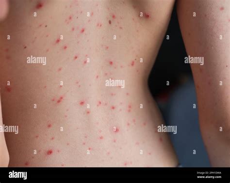 Chickenpox Teenager Hi Res Stock Photography And Images Alamy