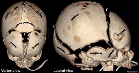 Fileskull Ct Normal Sutures 01 Embryology