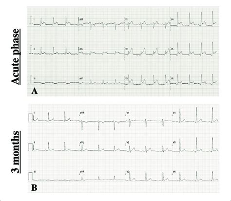 Ecg At Admission Demonstrating Diffuse Concave St Segment Elevation