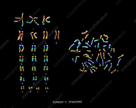 Turner S Syndrome Karyotype Stock Image C Science Photo