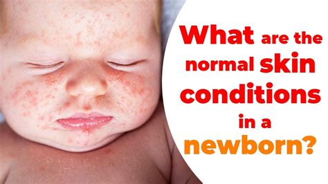 What Are The Normal Skin Conditions In A Newborn Dr Pankaj Parekh