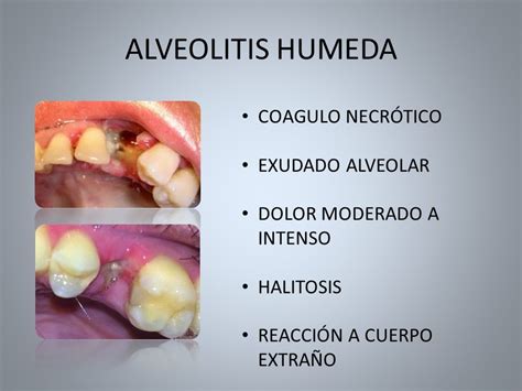 Encuentro Provincial De Residentes De OdontologÍa Higa Gral San MartÍn De La Plata Alveolitis