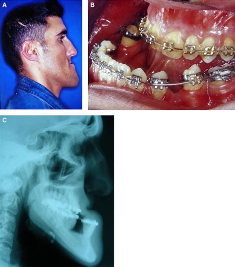 Incomplete Mobilization Of The Maxilla Resulting In Failed Maxillary