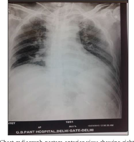 Figure 1 From A Case Of Malpositioned Catheter Via Supraclavicular