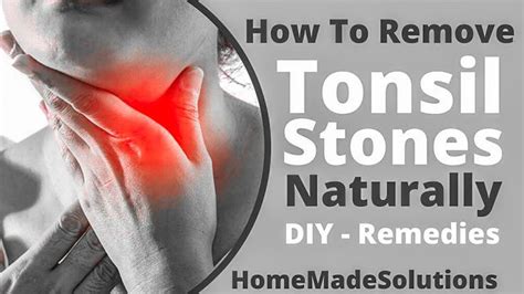 How To Get Rid Of Tonsil Stones At Home Remove Tonsil Stones