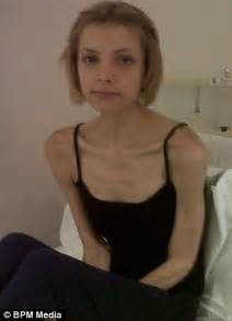 Anorexic Sian Clarke Is Passed Between FIVE Hospitals After Her