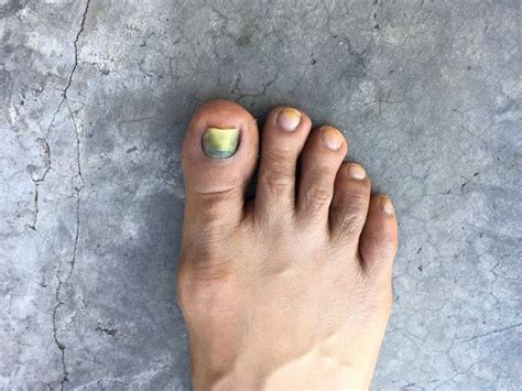 Toenail Disorders During Chemotherapy Prevention And Care