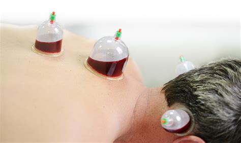how to detoxify yourself using chinese cupping therapy