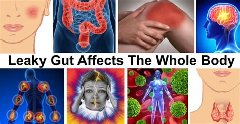Leaky Gut What It Is And How To Naturally Heal It