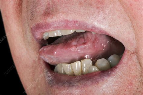 Tongue Wart Stock Image C0389494 Science Photo Library