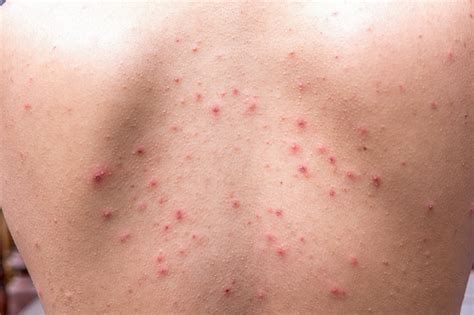 Untreated Severe Nodular Acne On Back Often Evolves To Atrophic Scars