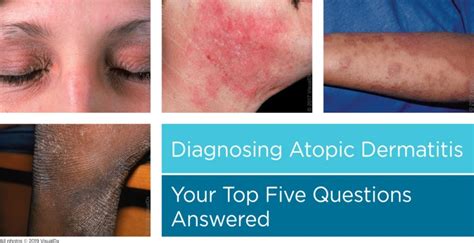 Diagnosing Atopic Dermatitis Your Top Five Questions Answered Visualdx