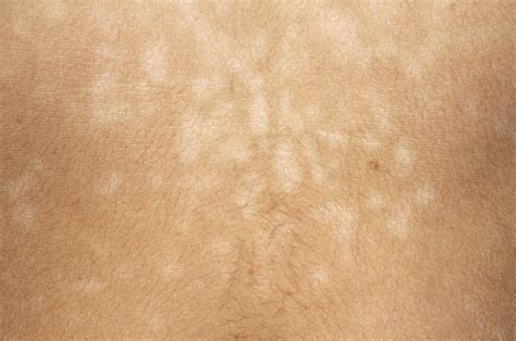 Pityriasis Versicolor Nhs