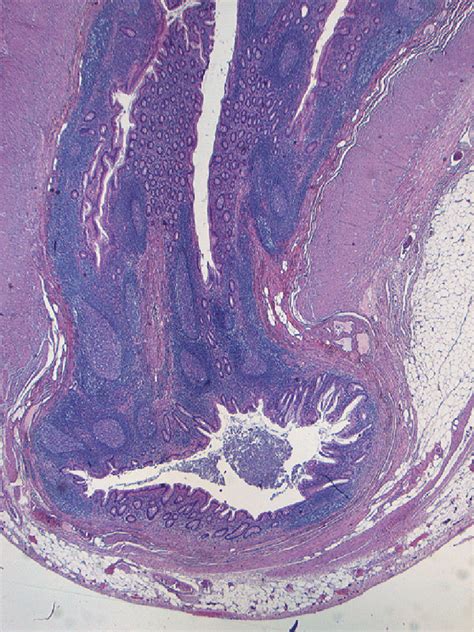 This Diverticulum Of The Appendix Lined By A Largely Unremarkable