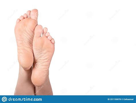 Cracked Heel On Woman Foot Female Feet Turned Up Dry Heels And Soles Woman On White Background