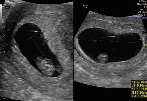 First Trimester Ultrasound Guidelines Radiology Key
