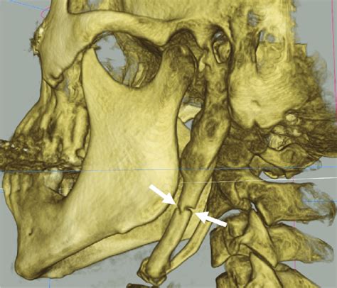 Three Dimensional Reconstruction Cone Beam Computed Tomography Image