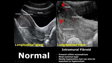 Intramural Sonography Cervix Mri Uterus Ultrasound Pathology