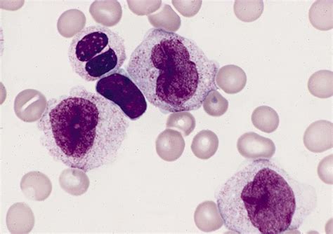 Pathology Outlines Acute Myelomonocytic Leukemia Fab Aml M4