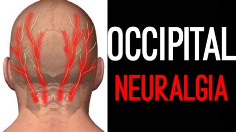 Occipital Neuralgia Occipital Headache Youtube