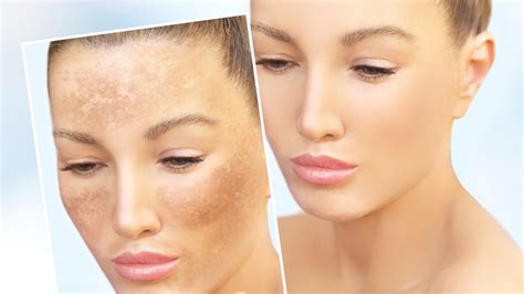Body Hyperpigmentation What Is It And Why Does It Happen