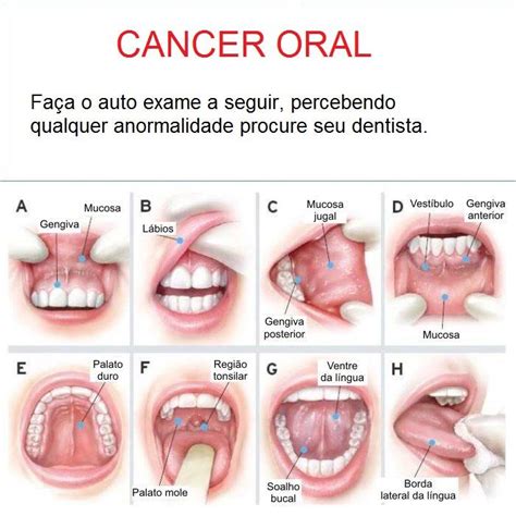 Câncer Oral Previna Se Faça O Autoexame Divulguem Compartilhem