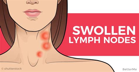 Painful Lymph Nodes In Neck Tikloaz