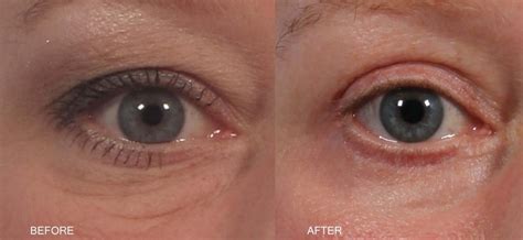 Lower Eyelid Skin Pinch Dr Brett Kotlus Cosmetic Oculoplastic