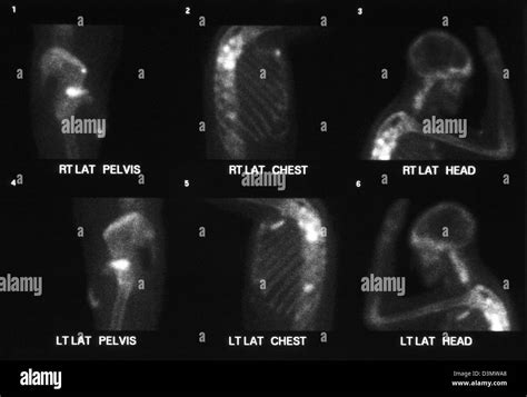Bone Scan For Cancer Showing Multiple Metastases To The Shoulder Ribs