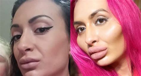 Instagram Model Addicted To Facial Filler Injections Now Has Biggest Cheeks In The World