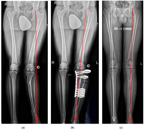 Jcm Free Full Text Corrective Osteotomies In Severe Non Idiopathic