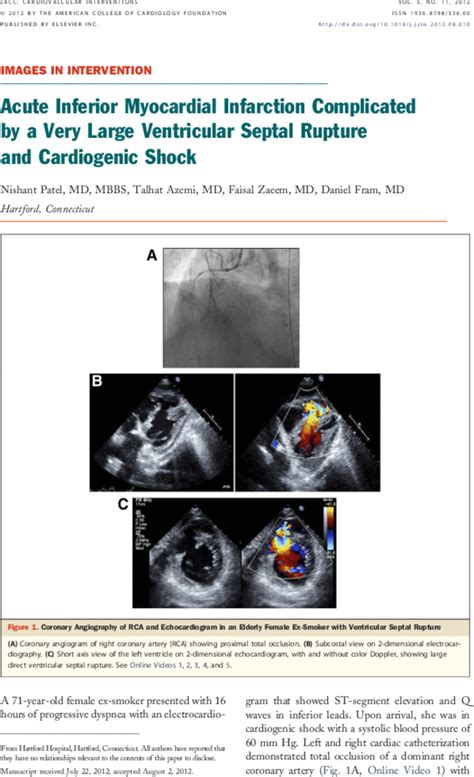 Acute Inferior Myocardial Infarction Complicated By A Very Large