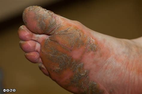 Hyperkeratotic Foot Eczema Reestheskinreestheskin