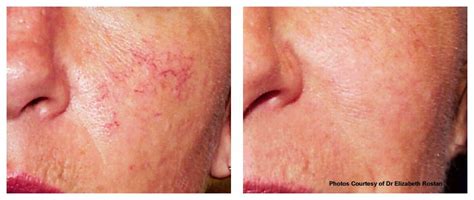 Facial Veins Damaged Capillaries Rosacea Treatment Proskin Clinics