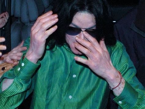 Did Michael Jackson Have Vitiligo