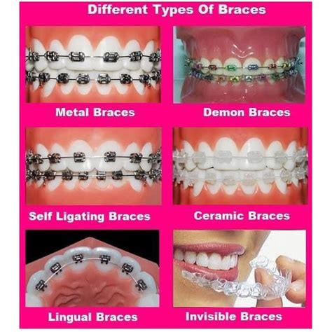 What Are The Various Types Of Braces Types Of Braces Ceramic Braces