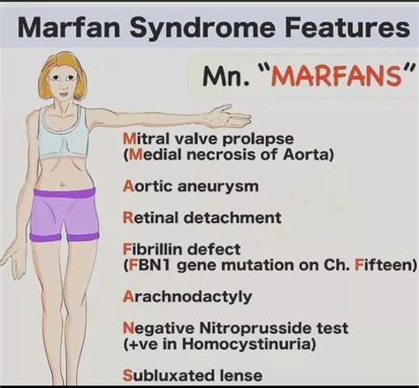 Understanding Marfan Syndrome Causes Symptoms And Management