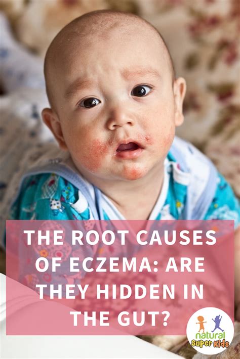 The Root Causes Of Eczema Are They Hidden In The Gut Baby Eczema