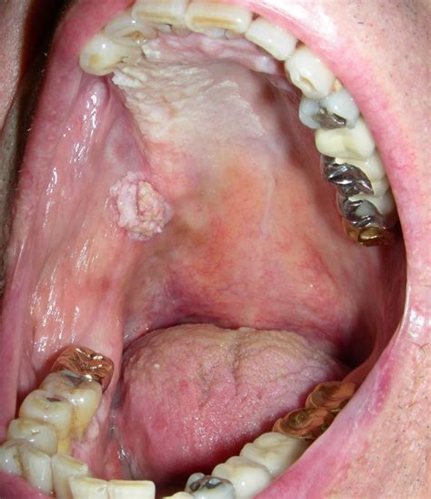 Roof Of Mouth Cancer