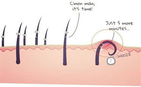 Passing a hair follicle drug test hair follicle tests are one of the hardest tests to cheat. How to get rid of ingrown hair forever | PINKVILLA