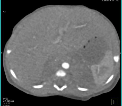 Neuroblastoma Of The Adrenals Adrenal Case Studies Ctisus Ct Scanning