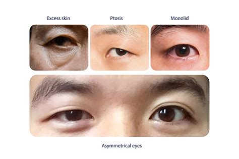 Four Reasons To Get Double Eyelid Surgery Dream Plastic Surgery