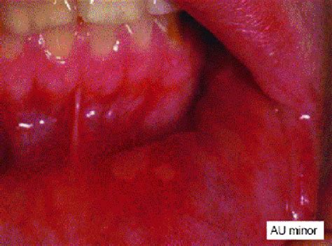 Minor Aphthous Ulcer Download Scientific Diagram