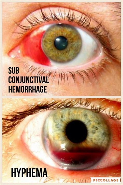 Subconjunctival Hemorrhage V Hyphema Natural Remedies For Arthritis