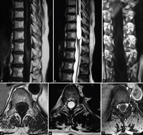 Mri Of The Spine Showed An Intra Axial Lesion Hypointense On T1 A And