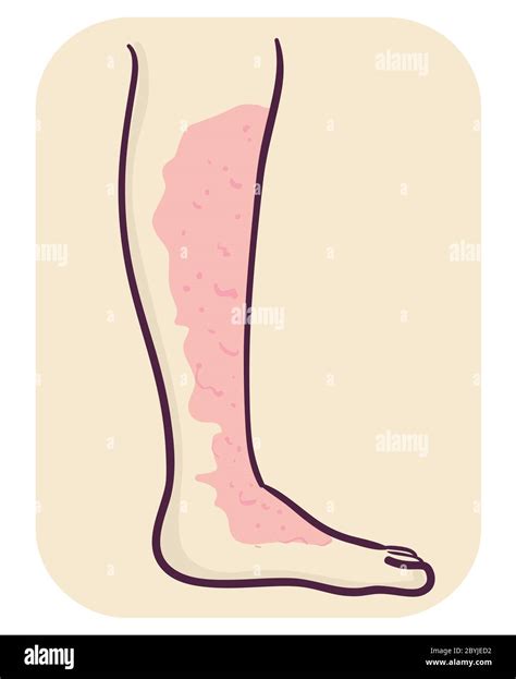 Illustration Of A Leg With Cellulitis Symptom Of Skin Infection Stock