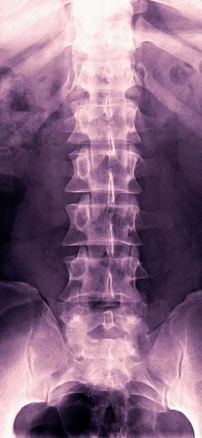 The presence of a lumbosacral transitional vertebra alters normal spine biomechanics. Normal Lumbar Spine, X-ray Photograph by Miriam Maslo