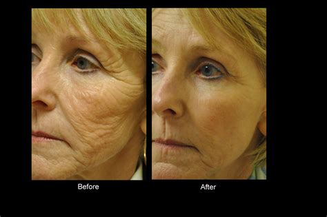 Bellevue Laser And Cosmetic Center Wrinkles